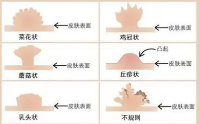 尖锐湿疣如何自我判断
