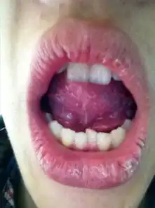 我这是尖锐湿疣吗
