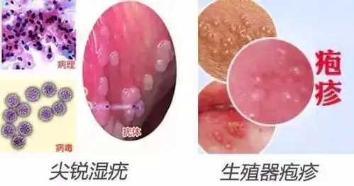 专家提醒女性比男性更容易染上尖锐湿疣,稍不注意就后悔终生
