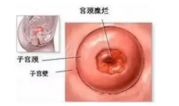 女性尖锐湿疣的临床表现及预防
