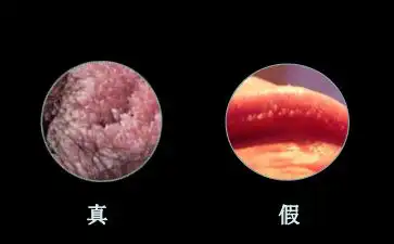 尖锐湿疣能治愈吗,假疣和真疣的区别图
