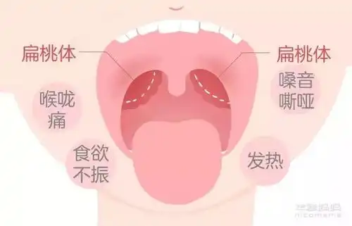 高烧疼痛吃不下饭,这种病绝大部分孩子都会中招
