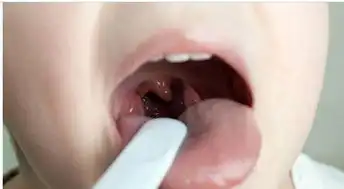 脖子上长出痘痘,可能是癌症的信号,大意不得
