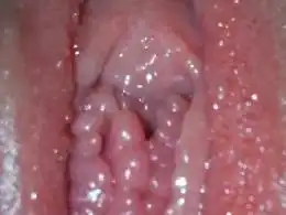 尖锐湿疣症状
