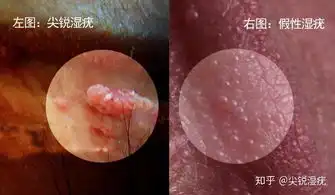 怎么区分珍珠疹和尖锐湿疣
