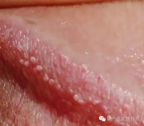 生殖器长了小疙瘩,一定是尖锐湿疣吗这篇文章值得偷偷收藏
