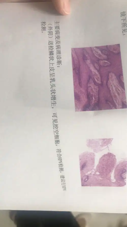 hpv转阴活检挖空细胞尖锐假性湿疣
