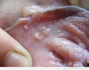 男性假性尖锐湿疣用什么药
