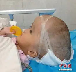 湖南大头娃娃缩脑成功颅内液体可装一脸盆
