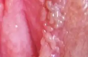 私处长了不痛不痒的小疙瘩,到底是啥啊
