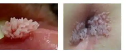 尖锐湿疣不可怕
