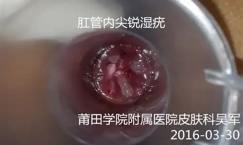 看图认识尖锐湿疣可能会引起不适,请您慎重点击
