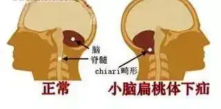 这些症状出现是脊髓在报警,严重可瘫痪
