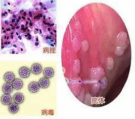 尖锐湿疣手术时到底有多痛
